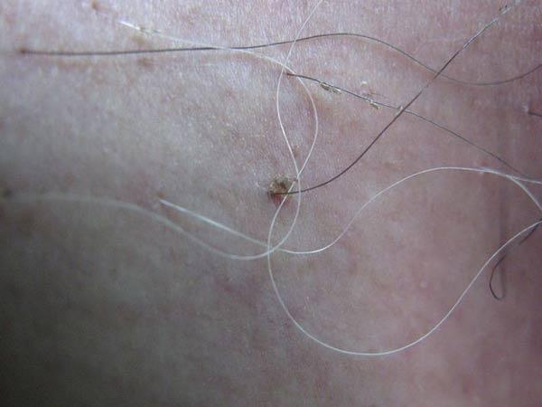 阴虱的虫卵藏在哪里阴虱卵真的在毛囊里吗？(阴虱卵是在毛囊里面吗）