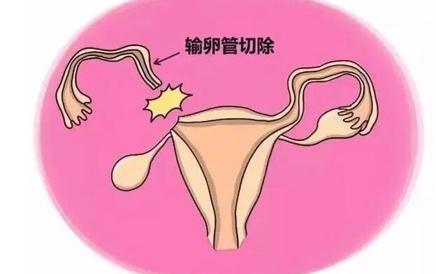 输卵管常见疑问解答，提高你的怀孕率(如何判断输卵管有无积水）