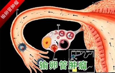 输卵管炎是盆腔炎吗(慢性输卵管炎什么症状）