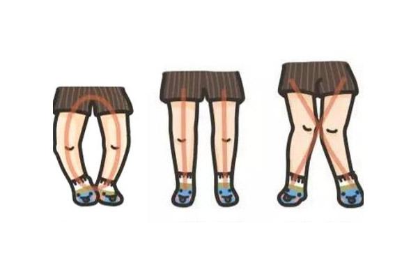 罗圈腿遗传吗？o型腿怎么矫正(o型腿遗传给了孩子怎么办）