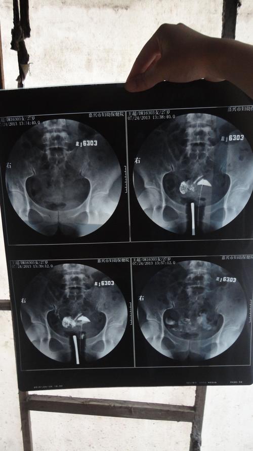 输卵管造影，女性备孕检查的第一道难关，真的疼痛难忍吗？(做输卵管造影后多久可以备孕）