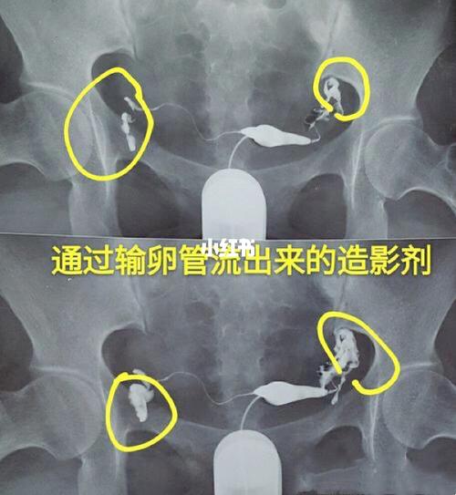 输卵管堵塞会排卵吗(输卵管不通最明显症状)