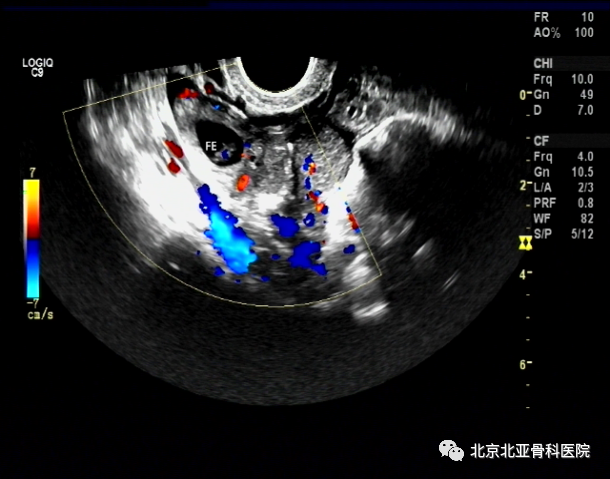 输卵管堵塞的女性该如何要孩子？(生过一个孩子输卵管会堵吗）