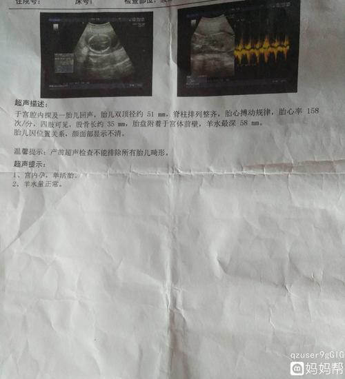 胎心率是怎么看男女的胎心率和宝宝性别有关吗(胎心率150是男孩还是女孩)