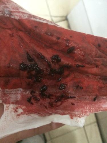 非经期出血有血块流出是什么原因(月经来血块是什么原因）