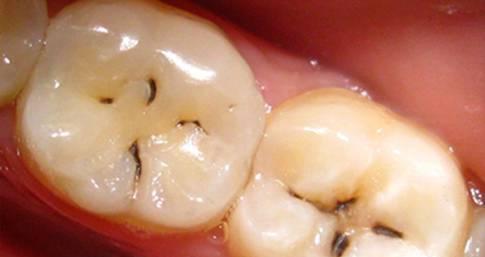 蛀牙怀孕前一定要拔吗(龋齿不拔对怀孕的影响）