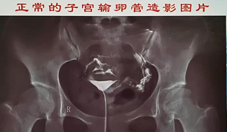 输卵管肿大的症状(输卵管图片高清真实图片）