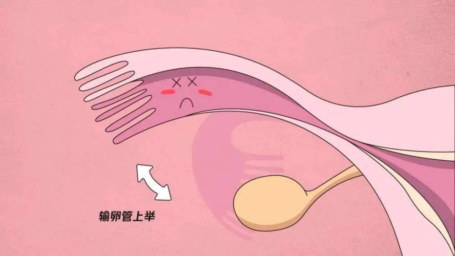 输卵管出现粘连是怎么回事？怎么才能怀孕呢？(输卵管粘连但是是通的）