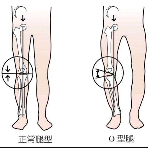 罗圈腿遗传吗？o型腿怎么矫正(o型腿遗传给了孩子怎么办）