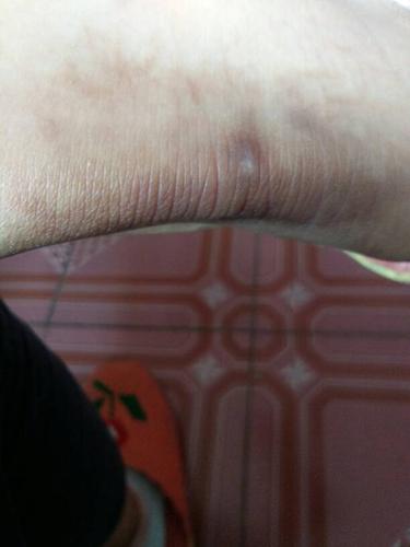 长期冻脚踝会不会导致不孕？(脚踝冻伤怎么恢复）