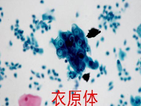 衣原体支原体不孕不育什么关系(女性有衣原体一般什么原因造成）