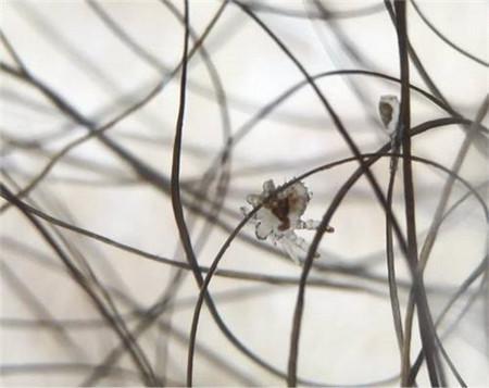 阴虱可以用盐水清洗吗阴虱怕盐吗？(白醋和盐可以杀死阴虱吗）