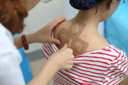 贴三伏贴可以洗澡吗(贴三伏贴可以洗头和洗澡吗)