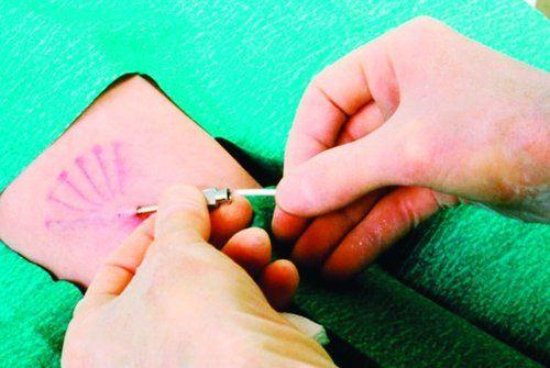 避孕针多少钱哪儿有(打手臂避孕针多少钱）