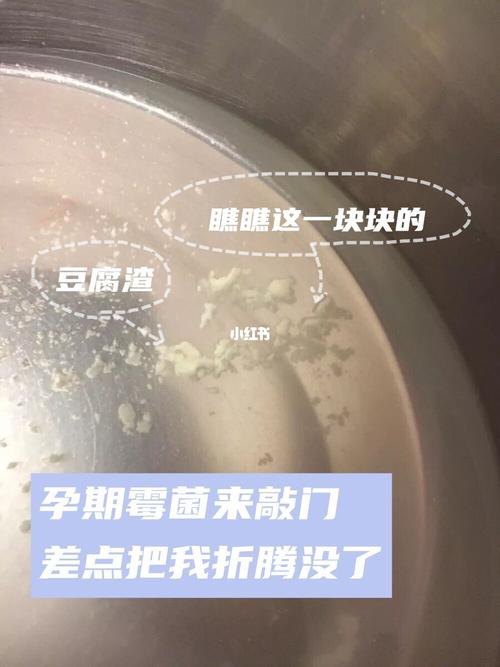 霉菌阳性影响怀孕吗(孕期患霉菌就是生男孩）