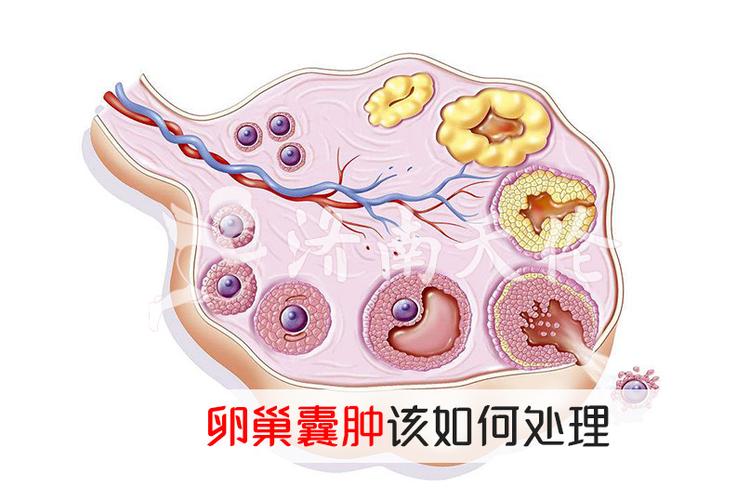 附件囊肿吃什么药会消(卵巢囊肿最怕三种运动）