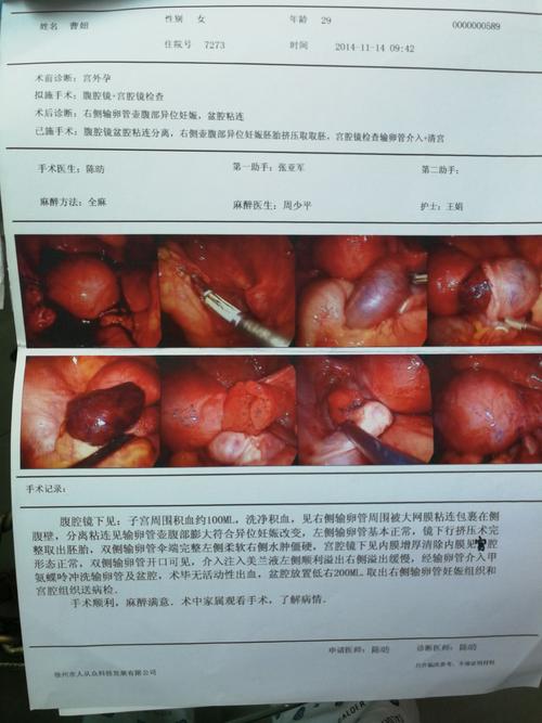 输卵管切除一边还可以怀孕吗(宫外孕说明男人的精子）
