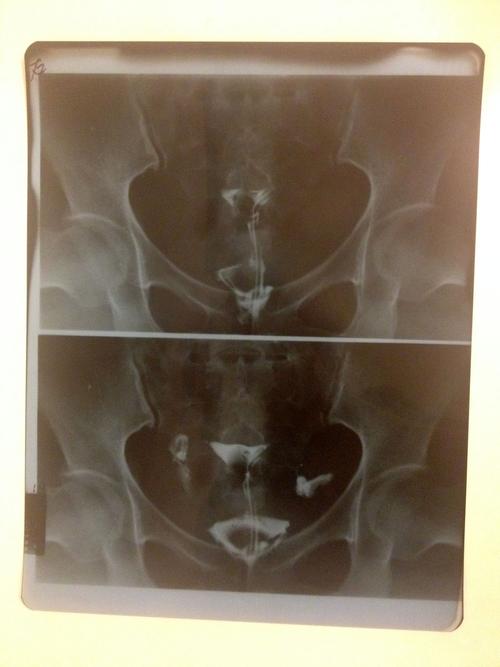 输卵管远端粘连严重吗(输卵管远端粘连如何治疗）