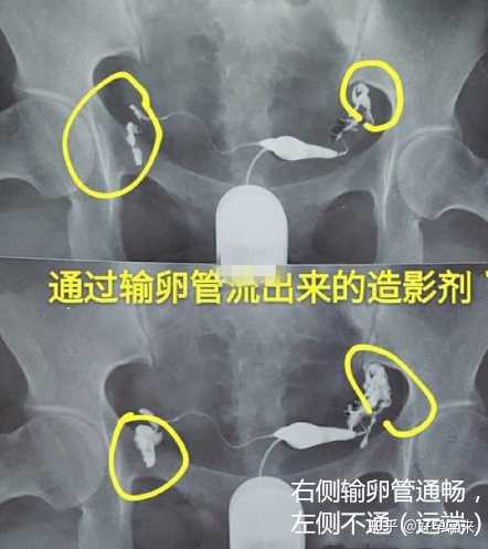 输卵管堵塞怎么能治好(输卵管堵塞做什么运动能疏通）