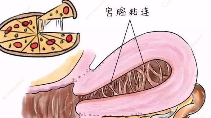 轻度宫腔粘连可以怀孕吗(宫腔粘连最明显的症状）