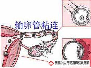输卵管粘连怎么治最好(吃中药输卵管居然通了）