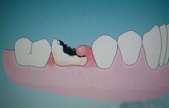 蛀牙怀孕前一定要拔吗(龋齿不拔对怀孕的影响）