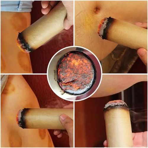 艾灸治疗原理是通过对穴位的热蒸和电的热敷作用,来治疗各类疾病