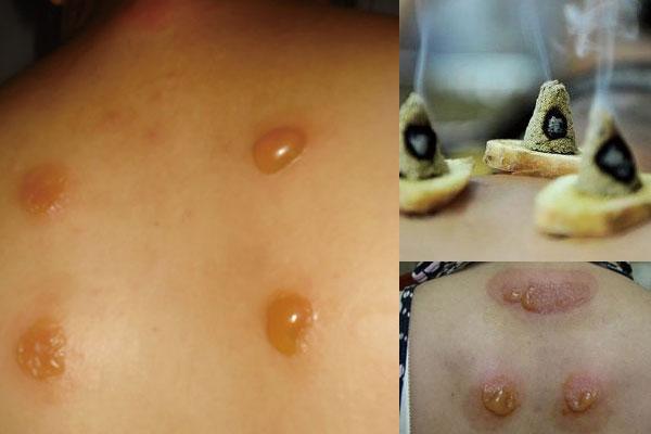 贴三伏贴后起水泡怎么回事(三伏贴起水泡反复出水怎么办)