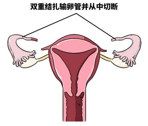 输卵管结扎对女性危害大，你还敢如此避孕吗？(女性结扎的危害有哪些）