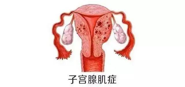 腺肌症痛经怎么办快速止痛(女生1一12级的痛经图)