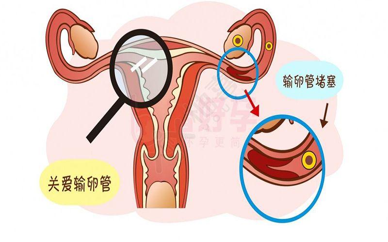 输卵管系膜囊肿影响怀孕吗(小姑娘为什么会得卵巢囊肿）