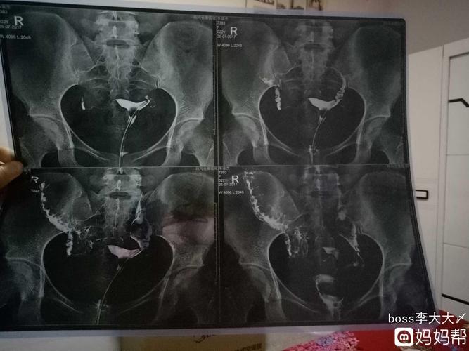 输卵管远端粘连严重吗(输卵管远端粘连如何治疗）