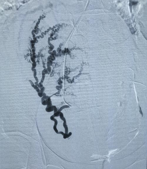 输卵管导丝介入后多久可以怀孕(做完导丝怀孕案例）