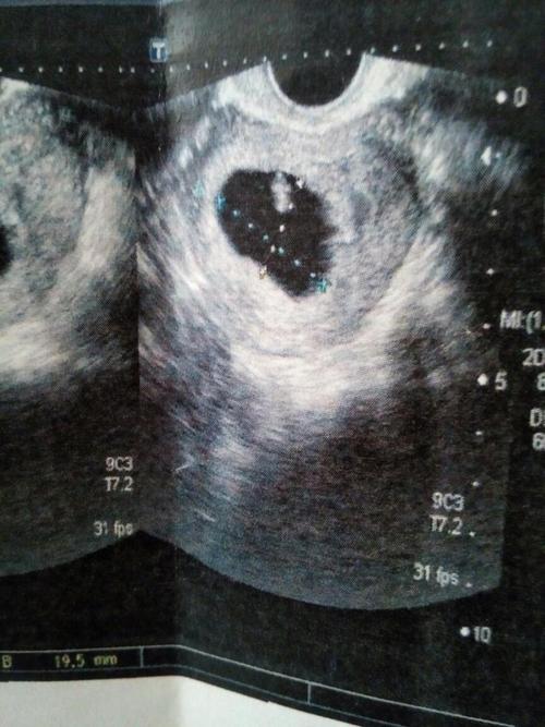 阴超和b超的区别有哪些(妇科b超和阴超哪个好）