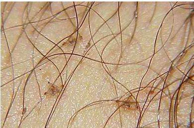 阴虱要看什么科室去医院不要搞错科室(阴虱怎么来的）