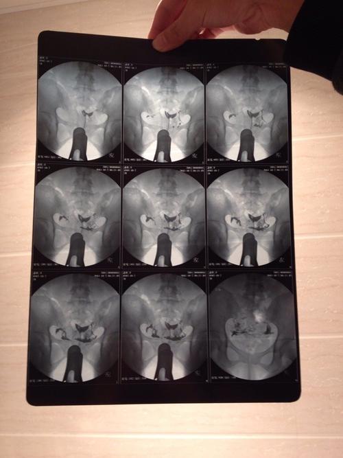 输卵管不通畅会怀孕吗(输卵管堵塞有什么样症状)