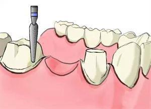 镶牙当月可以怀孕吗(镶牙多久后才能跟正常牙一样使用）