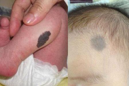 胸前有胎记代表什么(男人胸前有胎记好吗）