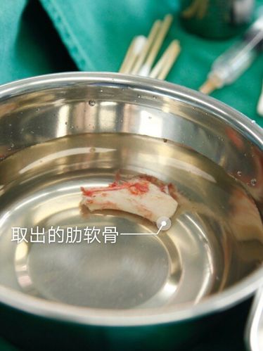 肋软骨缺一点会影响怀孕吗(肋软骨可以取几次）