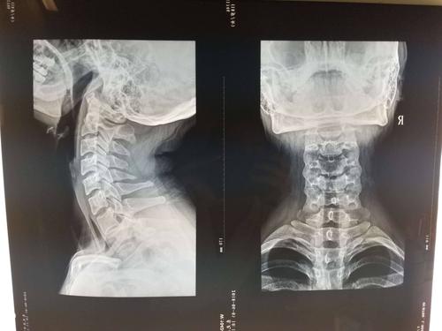 颈椎正侧位备孕可以拍片吗(做了颈椎ct后多久才能要孩子）