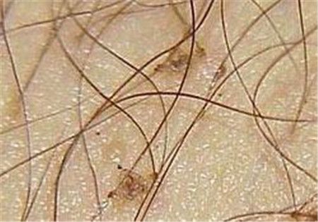 阴虱的潜伏期是多久不知不觉间你可以患上了阴虱！(阴虱在身体能潜伏多久）