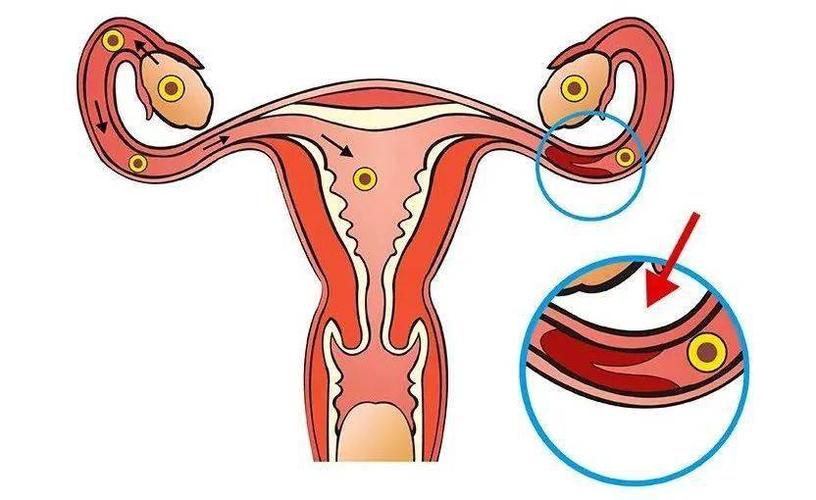 输卵管手术后备孕多久(一侧输卵管如何备孕）