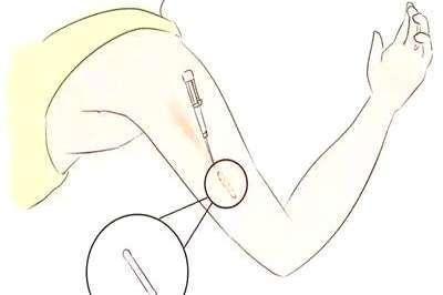 避孕针打屁股吗(避孕针打在什么部位图片）