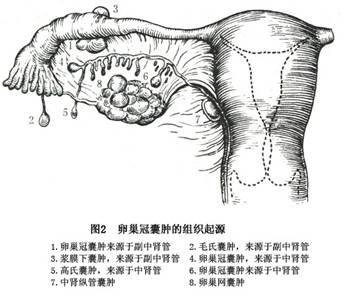 输卵管系膜囊肿怎么引起的(输卵管系膜囊肿怎么治疗）