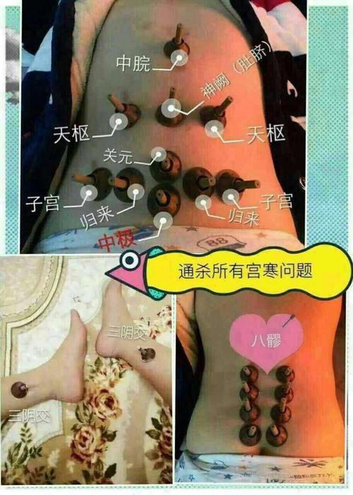 艾灸灸哪里助孕