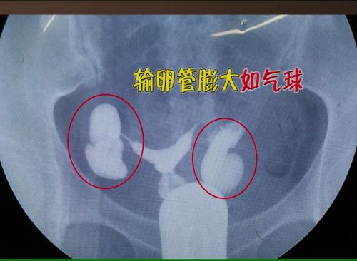 输卵管积水可以备孕吗(输卵管积水粘连还可以怀孕吗）