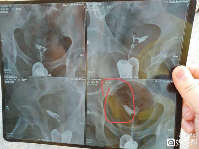 输卵管堵了还能自己通吗(输卵管两侧有堵塞会自己通吗）