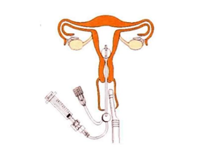 输卵管手术后备孕多久(一侧输卵管如何备孕）