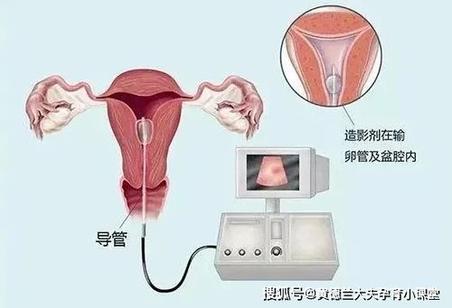 输卵管造影，女性备孕检查的第一道难关，真的疼痛难忍吗？(做输卵管造影后多久可以备孕）