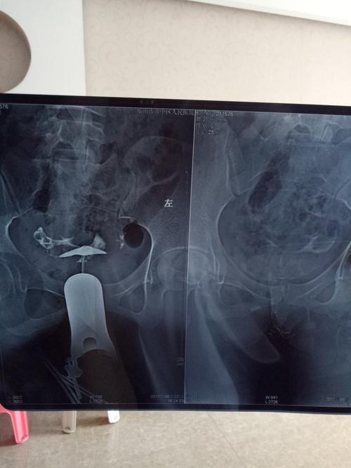 输卵管伞端粘连能自然受孕吗(输卵管伞端粘连是什么原因造成的）